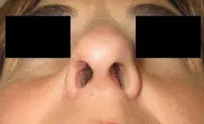 Benign Tumors Of The Nose service image