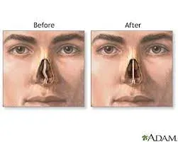 Septoplasty service image