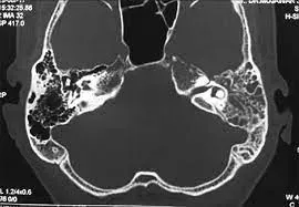 Treatment of complications of unsafe CSOM including intra and extra cranial abscess, labyrinthine fistula repair and others. service image
