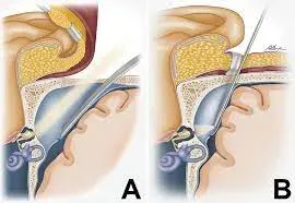 CSF Otorrhoea Repair service image