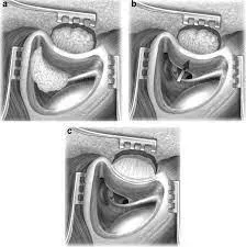 Posterior Tympanotomy service image