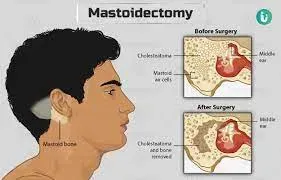 Modified Radical Mastoidectomy service image