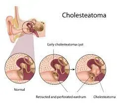 Mastoidectomy service image