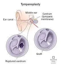 Tympanoplasty service image