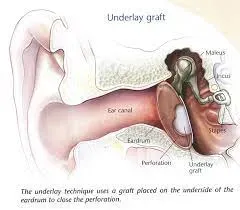 Myringoplasty service image
