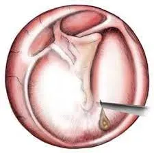 Myringotomy service image