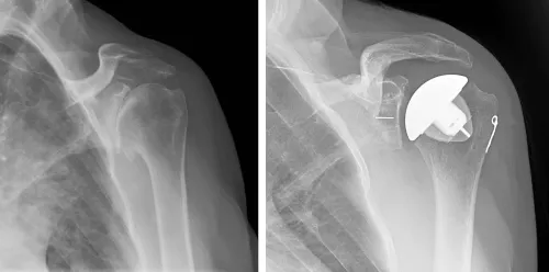 Shoulder Replacement Surgery service image
