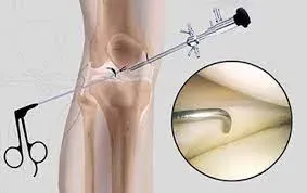 Knee Arthroscopy service image