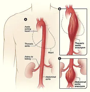Aortic Aneurysm service image