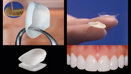 Porcelain Veneers service image