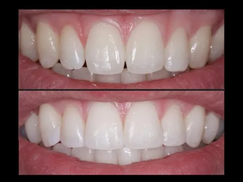Composite Bonding service image