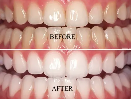 Teeth Whitening service image