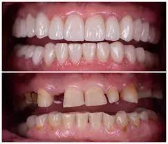 Full Mouth Rehabilitation service image