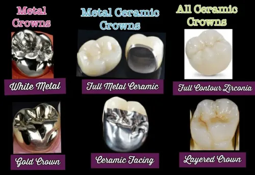 Ceramic Crown service image