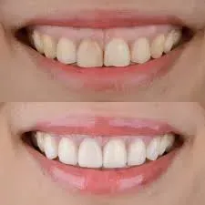 Gummy Smile service image