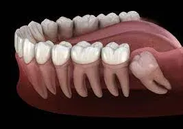 Wisdom Tooth removal service image