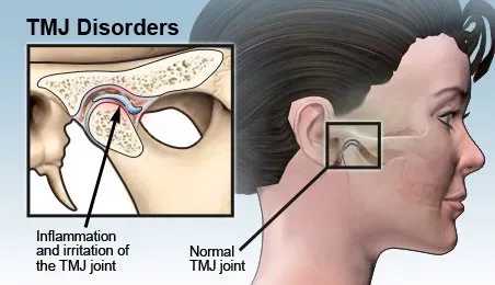 Temporomandibular Joint Disorders service image