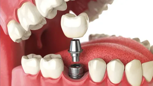 Dental Implant service image