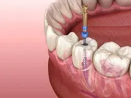 Root Canal Treatment service image
