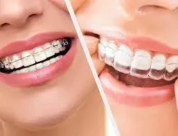 Braces Treatment service image