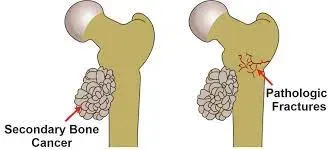 Pathological Fracture service image