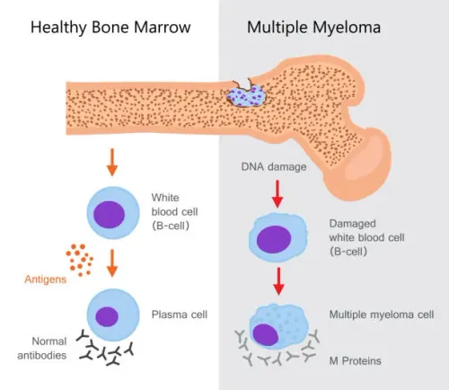Myeloma service image