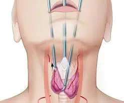 Thyroid Surgery Treatment in Rahatani,Kalewadi,Pimple Saudagar,PCMC service image