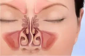 Adenoid Surgery Clinic in Rahatani,Kalewadi,Pimple Saudagar,PCMC service image