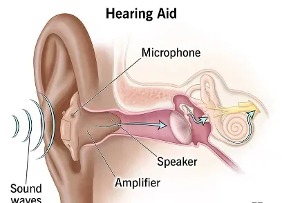 Hearing Aid Clinic in Rahatani,Kalewadi,Pimple Saudagar,PCMC service image