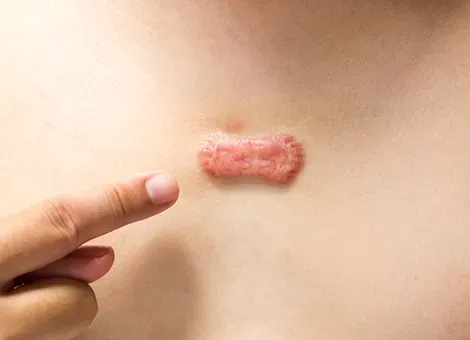 Keloid Excision Clinic in Rahatani,Kalewadi,Pimple Saudagar,PCMC service image