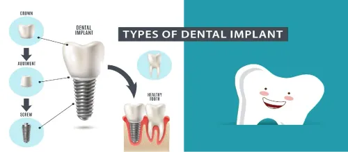 DENTAL IMPLANTS service image
