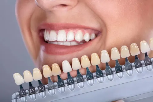 Cosmetic Veneers/Bonding service image