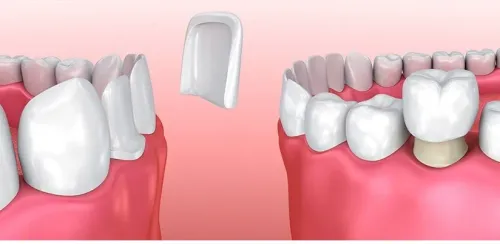 Ceramic Veneers / Crowns service image