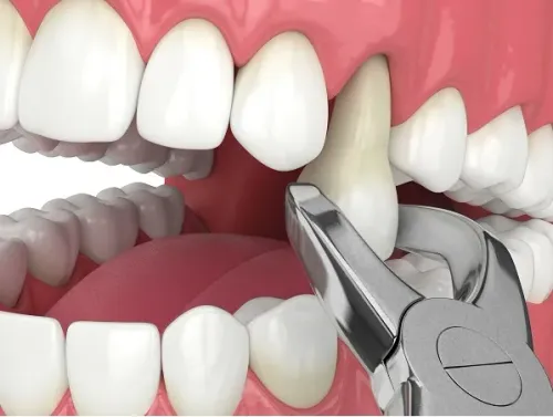  Tooth Extraction service image
