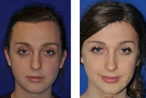 Facial Feminization Surgery service image