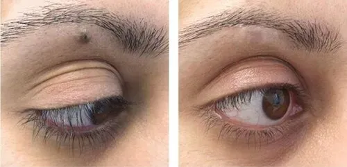 Skin tag and mole excision service image
