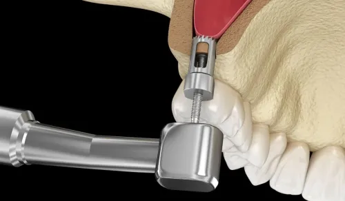 Sinus Lift Surgery service image