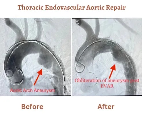 Endovascular Aortic Repair (EVAR) service image