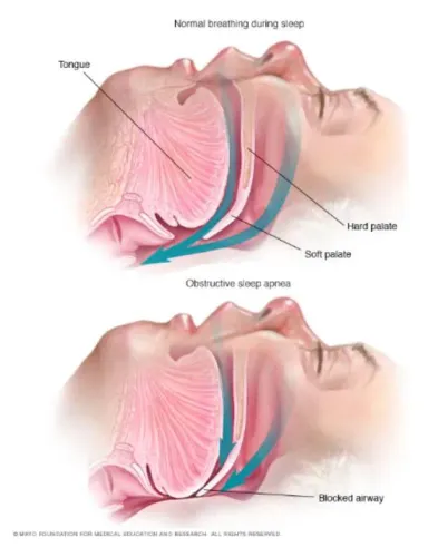 Obstructive Sleep Apnea & OSA service image