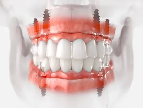 Jaw Implants service image