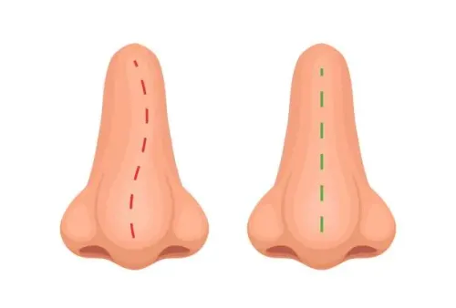 Cosmetic Nose Surgery -Rhinoplasty service image