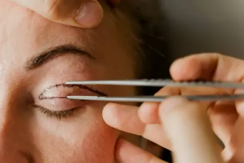 Cosmetic Eye Surgery (Blepharoplasty) service image