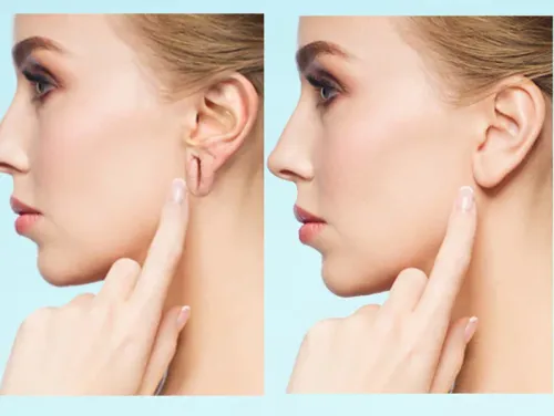 Ear Lobe Repair service image