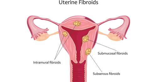 Fibroid Uterus service image