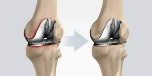 Revision Joint Replacement service image