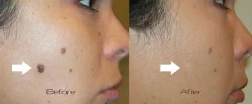 RADIOFREQUENCY CAUTERY Treatment service image