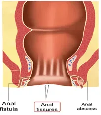 Fistula service image