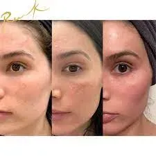 SKIN CHEMICAL PEELING  service image