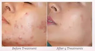 MESOTHERAPY FOR ACNE  service image