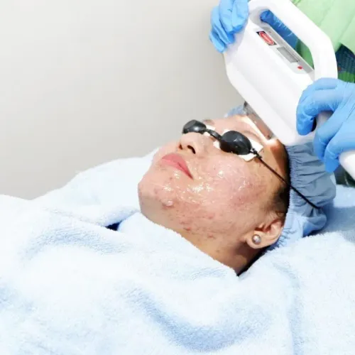 IPL LASER TREATMENT FOR ACNE  service image
